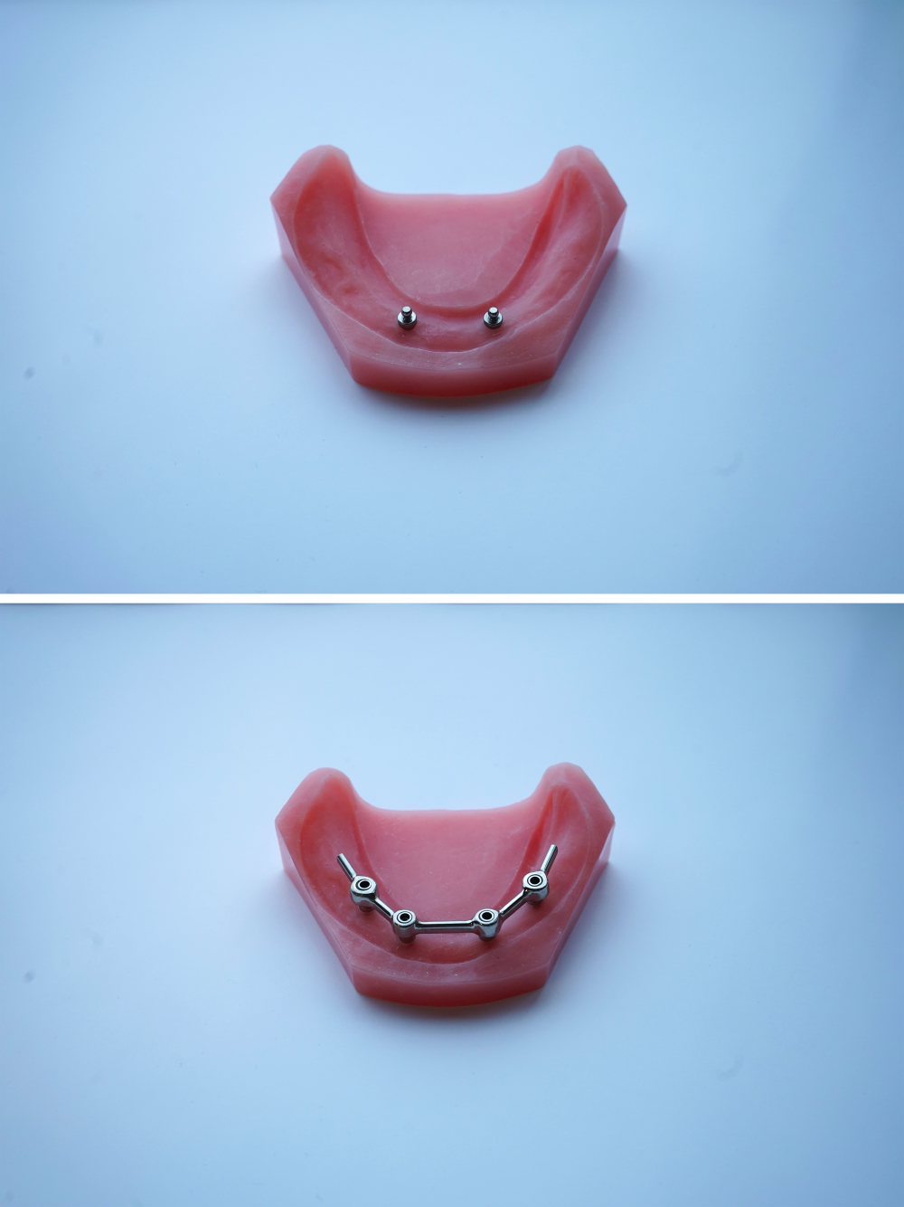 Prothèse sur implants